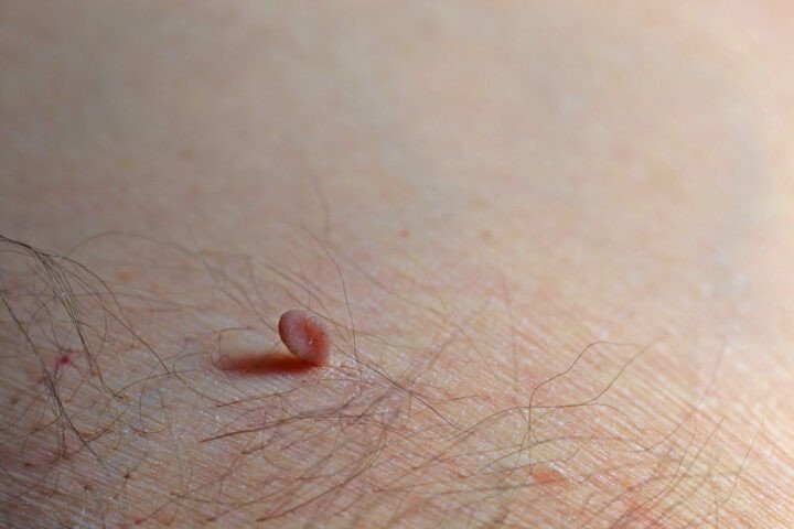 Khám phá các cách làm thịt dư rụng và chăm sóc da đúng cách